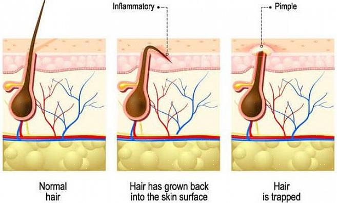 שיער צומח נפוץ אצל גברים שמתגלחים ובאנשים עם שיער מתולתל