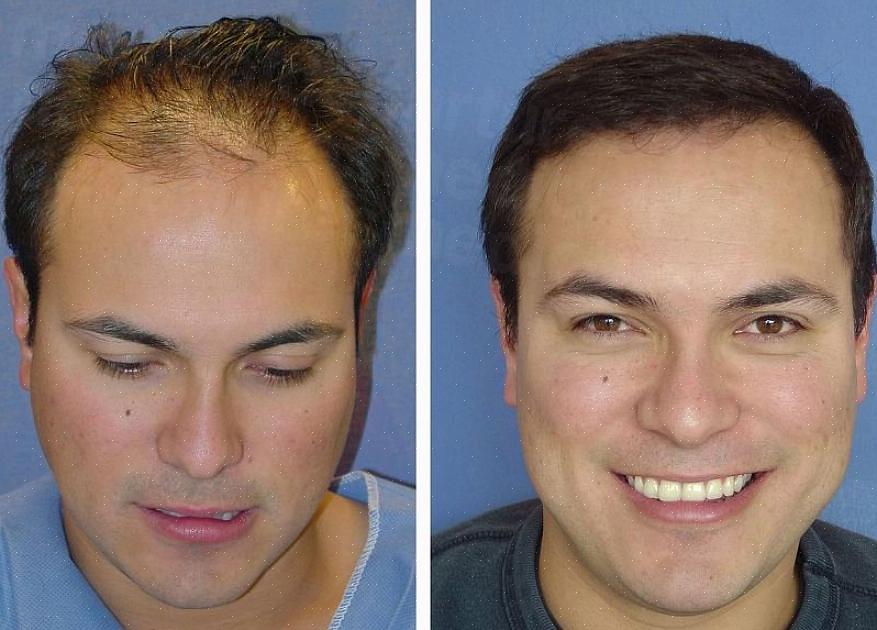 המנתח יחתוך את השיער מאזור התורם (החלק האחורי של הראש ממנו נלקחים השיער שיושתל)