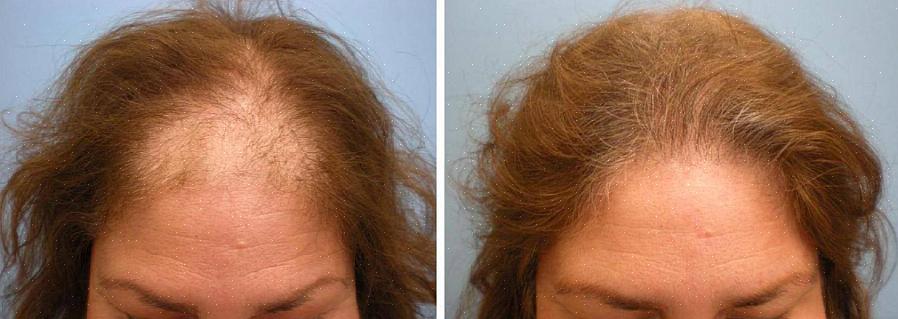 עתיד הטיפול בנשירת שיער מאיר ומתמיד בהיר הרבה יותר מבעבר