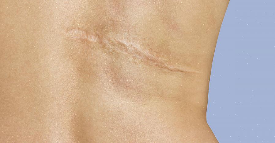 אם תאי העור צומחים מתעתקים מהר יותר מהפיברובלסטים לעור שלך תהיה צלקת דקה יותר או ללא צלקת בכלל