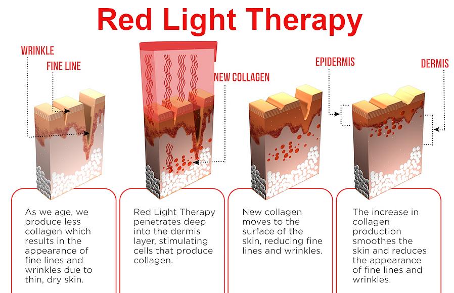 טיפול באור אדום או טיפול באור הוא סוג של טיפול המשפר את מרקם העור בצורה המהירה