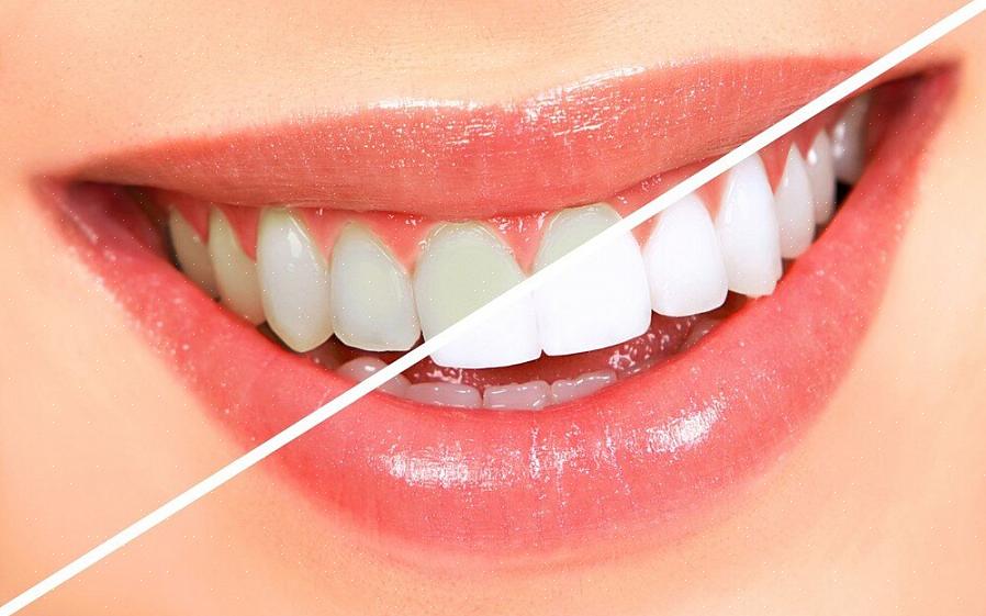ישנן דרכים רבות לגרום לשיניים להיראות לבנות יותר