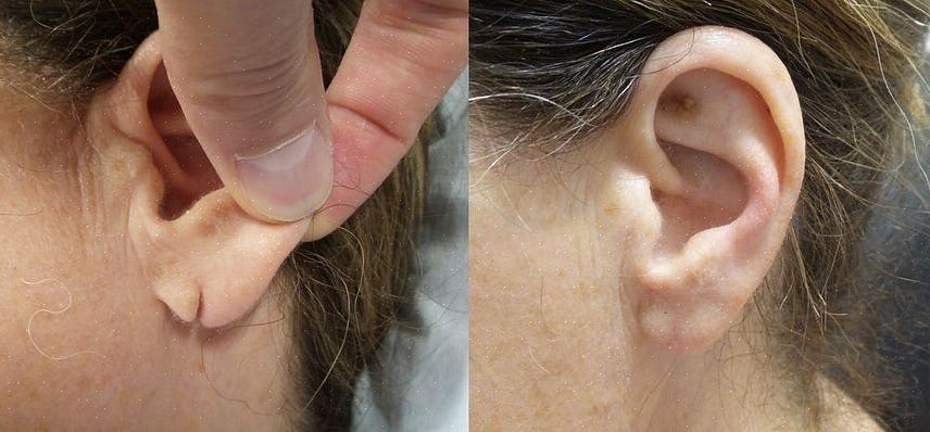 אם גודל החור של תנוך האוזן גדול מדי או שנרפא בגלל שימוש ארוך טווח בעגילי מד גדולים