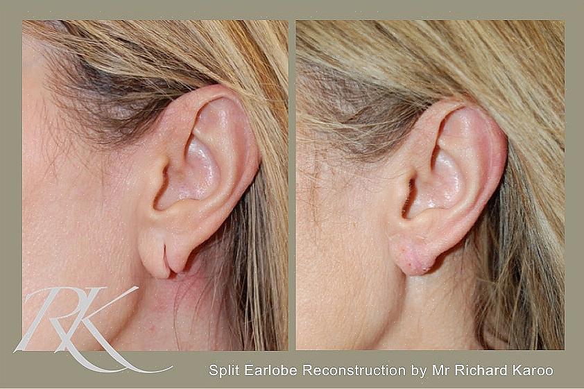 משקל העגילים מתבצע על חור תנוך האוזן ובסופו של דבר מאריך את החור