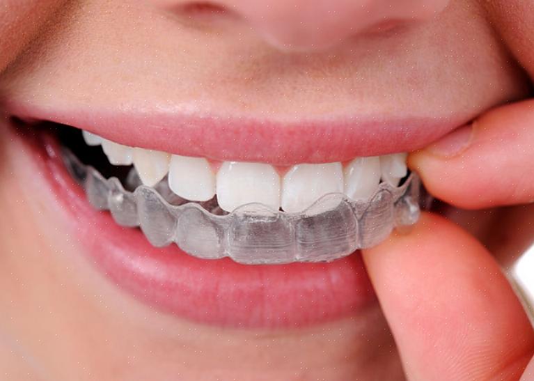 זו הסיבה שרוב בעלי Invisalign מסירים את הדבר הזה בעת אכילה ושתייה