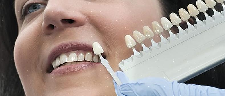 ציפוי שיניים יכול לגרום לשיניים להראות לבנות יותר